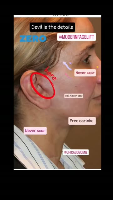 When it comes to facelifts, the incision placement is everything! While all full facelifts require s