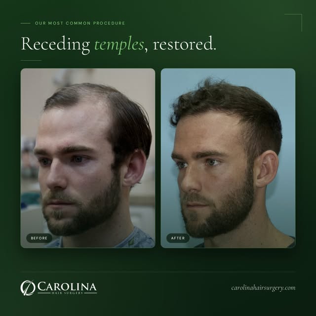 Temples first. Almost always...

Male pattern hair loss rarely starts at the crown. It starts at the