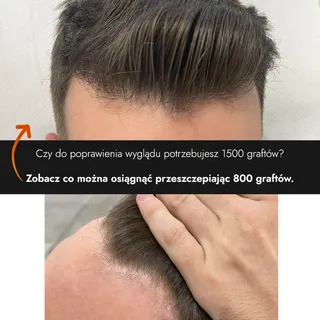 Czy do poprawienia wyglądu potrzebujesz aż 1500 graftów? 🤔
Zobacz co można osiągnąć przeszczepiając