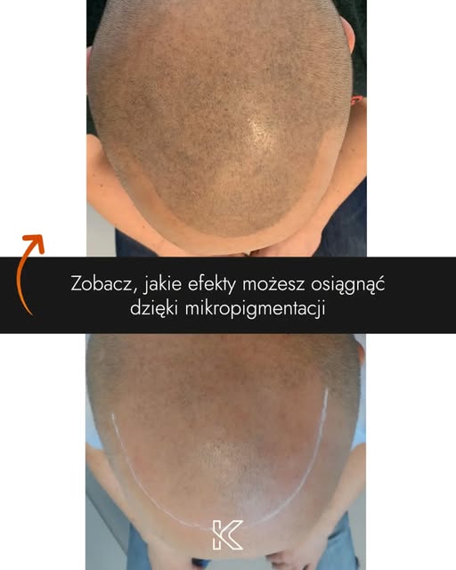 Zobacz, jakie efekty można osiągnąć dzięki mikropigmentacji skóry głowy 🧑‍🦲👉🧑‍🦰

Problem dotycz