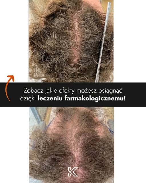 Oto kolejna metamorfoza po leczeniu farmakologicznym w Kierach Medical Clinic 🧑‍🦲👉🧑‍🦰

Problem 