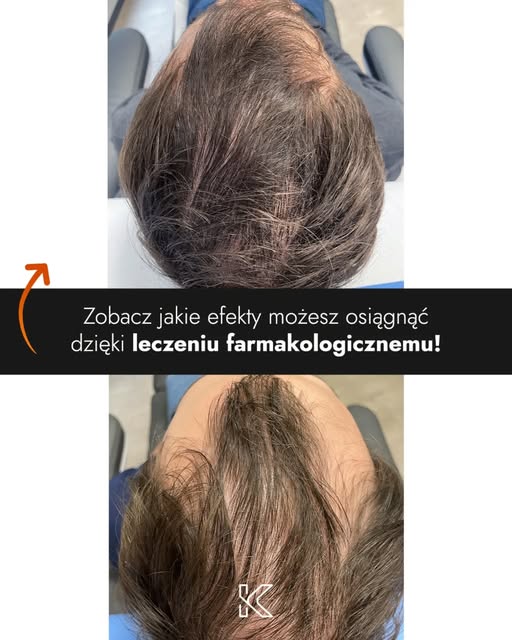 Oto kolejna metamorfoza po leczeniu farmakologicznym w Kierach Medical Clinic 🧑‍🦲👉🧑‍🦰

Problem 