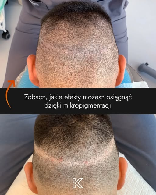 Zobacz, jakie efekty można osiągnąć dzięki mikropigmentacji skóry głowy 🧑‍🦲👉🧑‍🦰

Problem dotycz