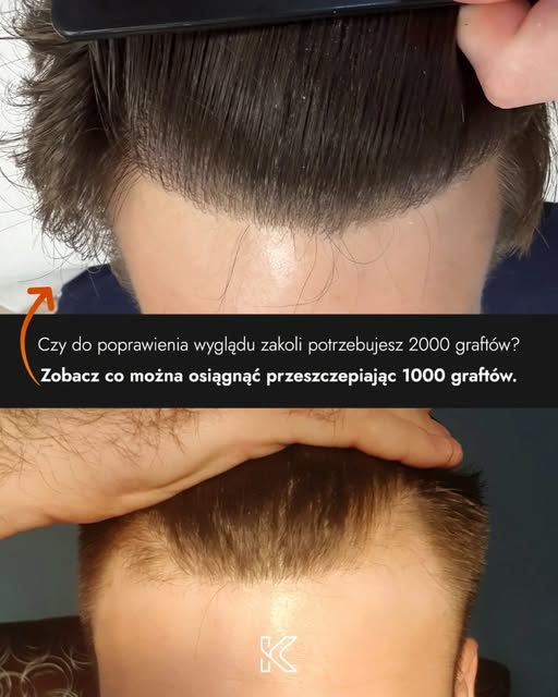Czy do poprawienia wyglądu potrzebujesz aż 2000 graftów? 🤔
Zobacz co można osiągnąć przeszczepiając