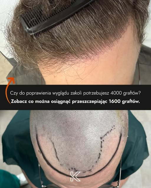 Czy do poprawienia wyglądu potrzebujesz aż 4000 graftów? 🤔
Zobacz co można osiągnąć przeszczepiając