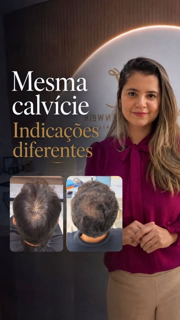 Nem todo paciente com queda de cabelo tem indicação para transplante.

No consultório, uma das coisa