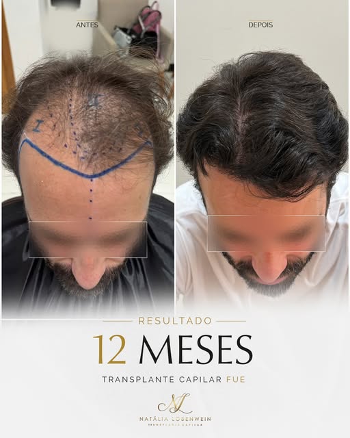 12 meses de evolução após o Transplante Capilar FUE
Um ano pode fazer uma grande diferença quando ex