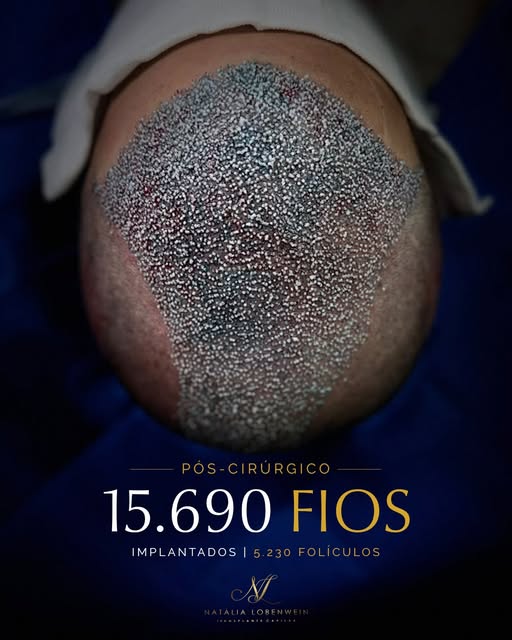 15.690 fios implantados | 5.230 folículos
O dia do transplante marca o início de uma nova etapa.

Ne