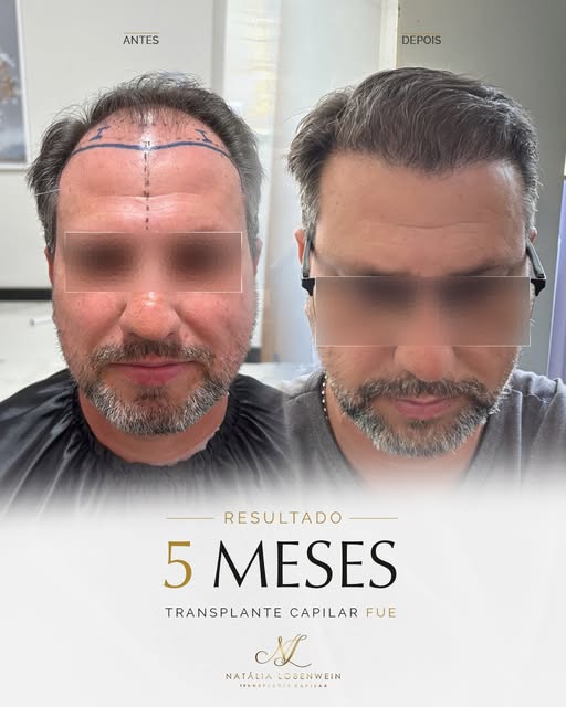 ⚜️ 5 meses de evolução. 
Um resultado que mostra como o transplante capilar é um processo progressiv
