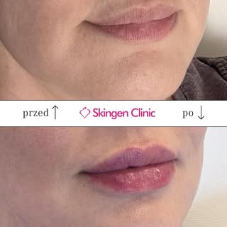 Subtelna korekta ust, która doda pewności siebie w codziennych sytuacjach. W Skingen Clinic osiągamy