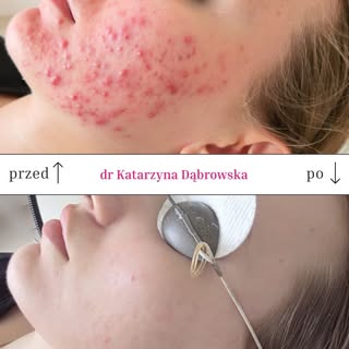Tak spektakularnie rozprawiamy się z trądzikiem w Skingen Clinic.

Taki efekt to rezultat kompleksow