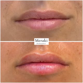 No queríamos unos labios distintos.
Queríamos estos labios, pero en su mejor versión 🫶🏼👄

#tratam