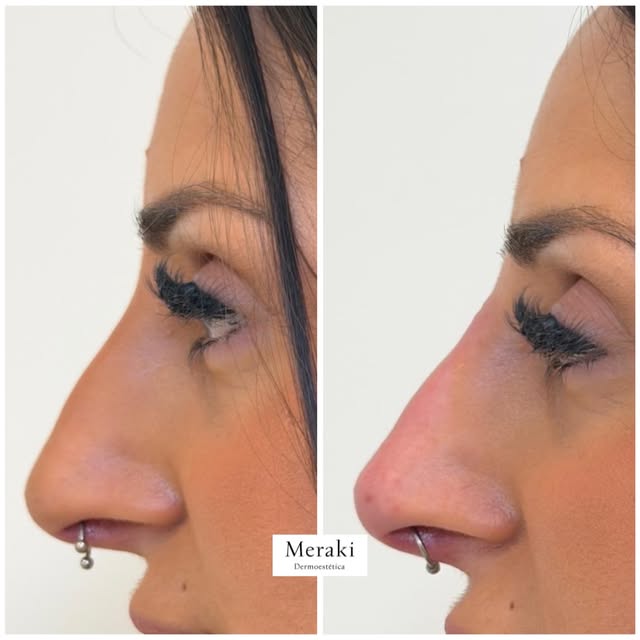 A veces, un pequeño cambio en el perfil cambia muchísimo la percepción del rostro 💉👃🏽

Con una ri