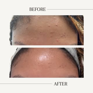 Only ONE day apart! 😱
 Breaking out right before a big event? Don’t stress — we’ve got you covered.