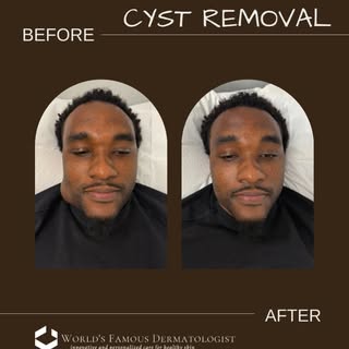 What a transformation 🙌🏽✨ 

This young man had been dealing with a painful jaw cyst for weeks — no