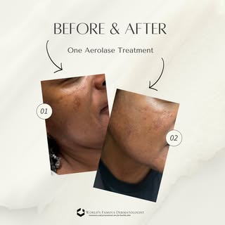 Hard to believe this glow came from just ONE Aerolase treatment! 🤯

This laser is a game changer fo