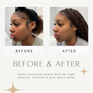 From Flaring to Flawless ✨

In just 2 weeks, this beautiful patient’s facial seborrheic dermatitis c