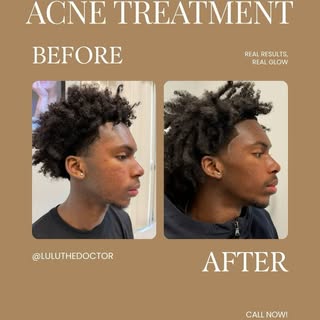✨ Real results. Real confidence. ✨

This young man came to me in July with active pustular acne and 