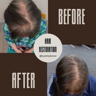 If your hair is thinning, this is for you. From a visible scalp to full restoration in only 3 months