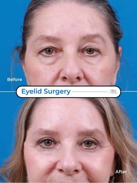 She still looks like her.
Just more awake.
This patient wanted brighter, more open eyes — not a diff