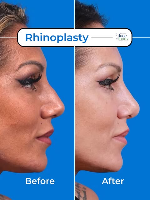 It’s not just the nose.
UCLA researchers used AI to analyze before-and-after rhinoplasty photos and 