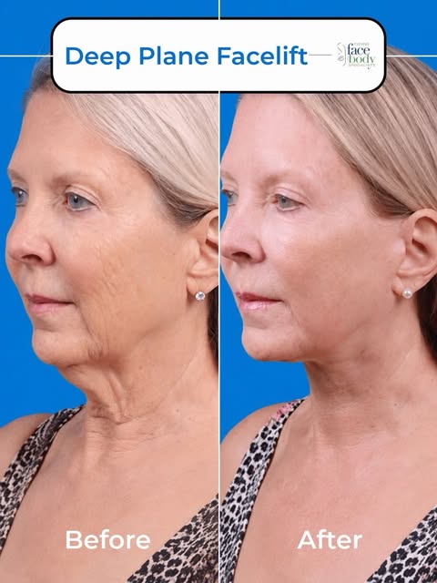 A Deep Plane Facelift with Structural Neck Lift doesn’t simply pull the skin tighter. It repositions