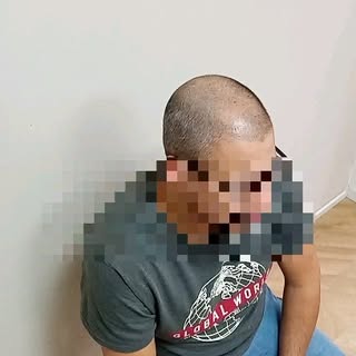 Generando más densidad con la micropigmentación capilar. Primera sesión, para este caso vamos a nece