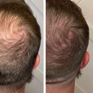Precision. Detail. Results.
Natural density restored.

#smp #hairdensity #hairtransformation #hairlo