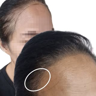 One of the most common concerns we see is thinning around the temples and hairline. This beautiful r