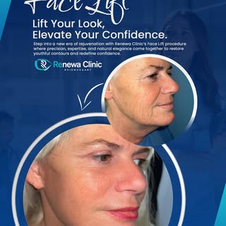 Step into a new era of rejuvenation with Renewa Clinic’s Face Lift procedure where precision, expert