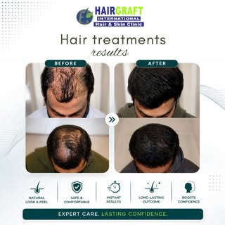 The difference speaks for itself.

A natural-looking hairline and fuller hair can make a real differ