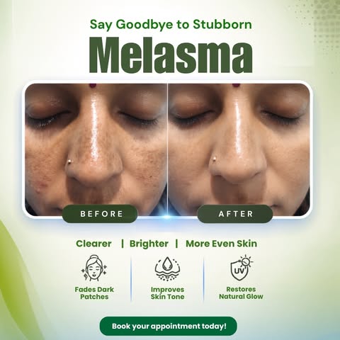 ✨ Rebuild. Renew. Reveal. ✨

Struggling with acne scars, open pores, pigmentation, or uneven skin te