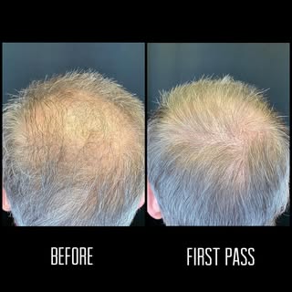 Check out this first pass of scalp micropigmentation!

With each pass we are building the appearance