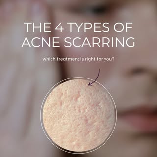 Different scars need different solutions:

☑️ Ice Pick: TCA Cross

☑️ Boxcar: RF microneedling + TCA