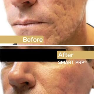 Before ➝ After ✨

This result was achieved using a targeted combination approach, with subcision as 