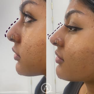 Small Adjustments. Big Balance. ✨

Non-surgical nose enhancement is about refining proportions, not 