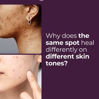 Acne doesn’t heal the same way on every skin tone.

In deeper skin tones, acne is more likely to tri
