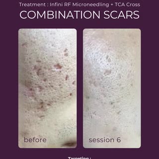 Targeting different scars requires different techniques. ✨

This result was achieved after 6 session