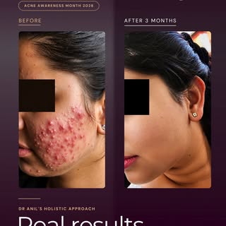 Most acne treatments only treat what is visible on the surface. 

But acne-prone skin is dealing wit