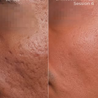Why do standard treatments sometimes fall short for deep acne scarring? Because no two scars are the