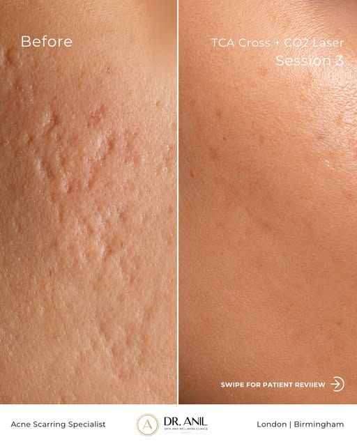 In just 3 Sessions✨

TCA Cross + CO2 Laser working together. This is what happens when the treatment