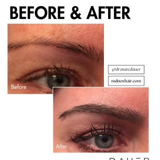 Before ➡️ After
⠀⠀⠀⠀⠀⠀⠀⠀⠀
Every graft placed with intention - following natural growth patterns for 