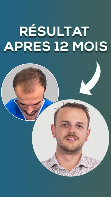 À 25 ans, Romain a osé sauter le pas. 7 mois après sa greffe de cheveux chez Capilclinic, il nous pa