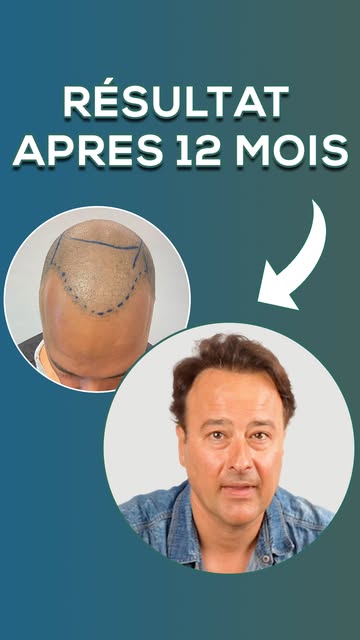 "J'avais peur de perdre mes cheveux..." 

Faire le premier pas vers une greffe de cheveux suscite to