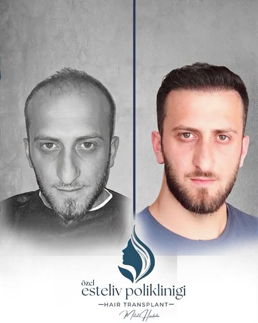 Doğru saç ekimi, doğru soruyla başlar: Saçınıza ne uygun? 🔥

Planlama aşamasında saç çizgisi, mevcu