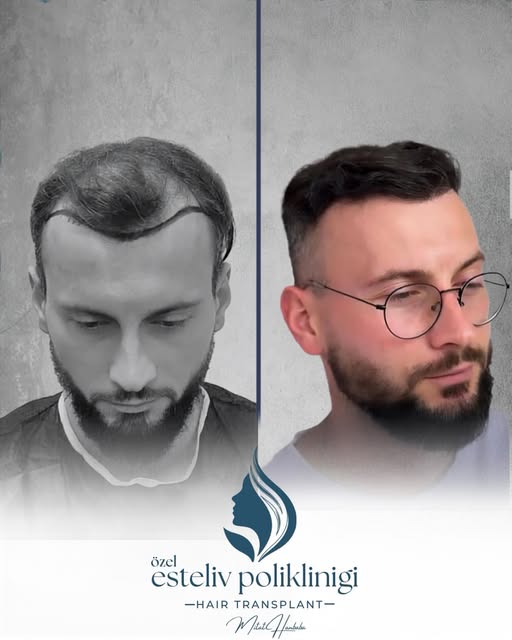 Bir saç çizgisi, yüzün bütün ifadesini tamamlayan önemli bir detaydır. ⚡️✅

Saç ekimi planlamasında 