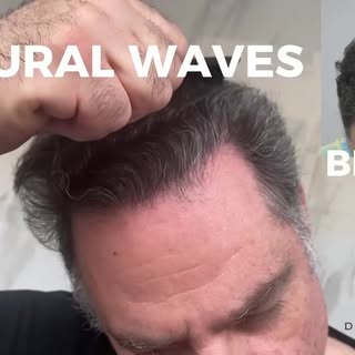 Witness the incredible journey of our client who underwent a life-changing hair transplant with Dr. 