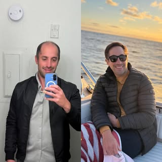 5,300 graft transplant transformation. What makes this case so unique is that he had a very weak don