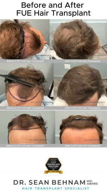 #HairTransplant #FUE #FUEHairTransplant #HairRestoration #HairTransplantResults