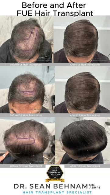 #HairTransplant #FUE #FUEHairTransplant #HairRestoration #HairTransplantResults